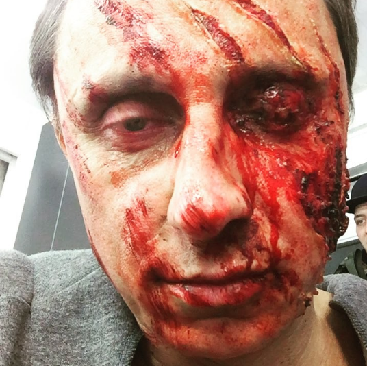 Вадим Галыгин поверг в шок фанатов снимком с обезображенным лицом