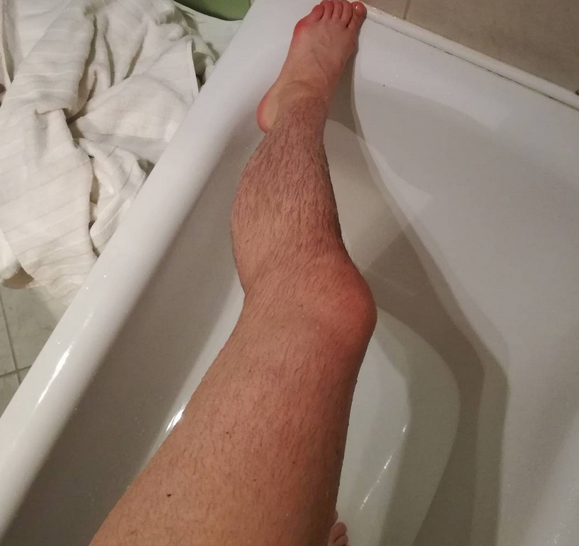 Со скольки лет можно брить ноги девочкам. Отказ от бритья ног. Неправильно бритые ноги.