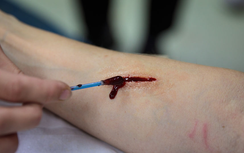 Новая разработка учёных печатает слои "био-чернил" прямо на пациенте, в буквальном смысле заклеивая рану полосками клееподобного вещества, из которого впоследствии вырастет настоящая новая кожа. Фото Getty