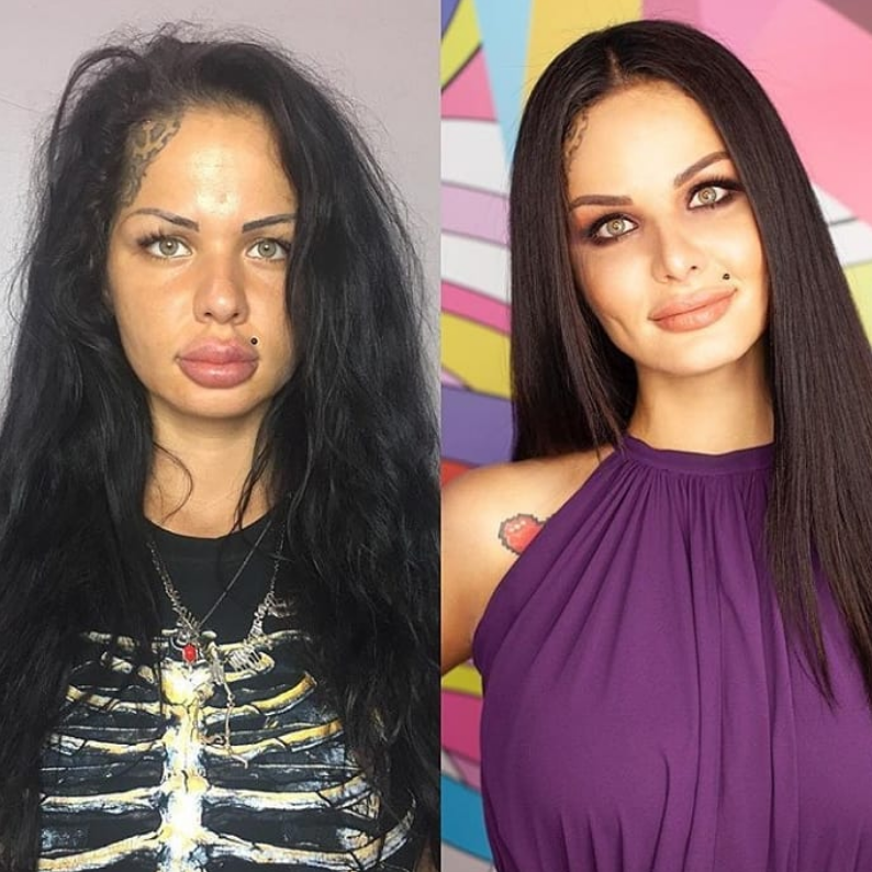 Фото губ накаченных до и после у девушек