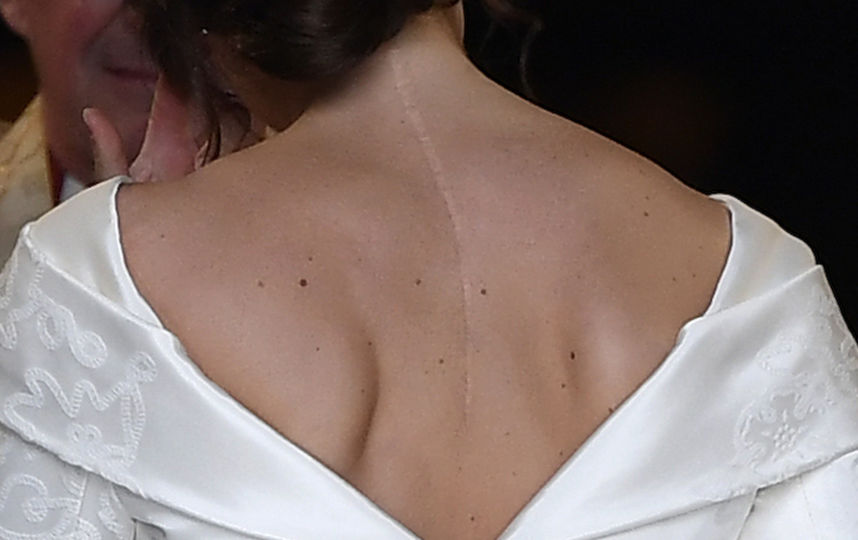 Шрам на спине принцессы Евгении. Фото Getty