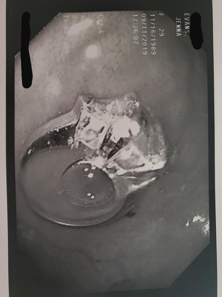 Врачи решили провести верхнюю эндоскопию желудка. Фото https://www.facebook.com/jenna.evans.121/