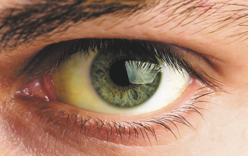 Почему глаза желтые и кожа желтая. Пожелтение склер гепатит. Иктеричность конъюнктивы.