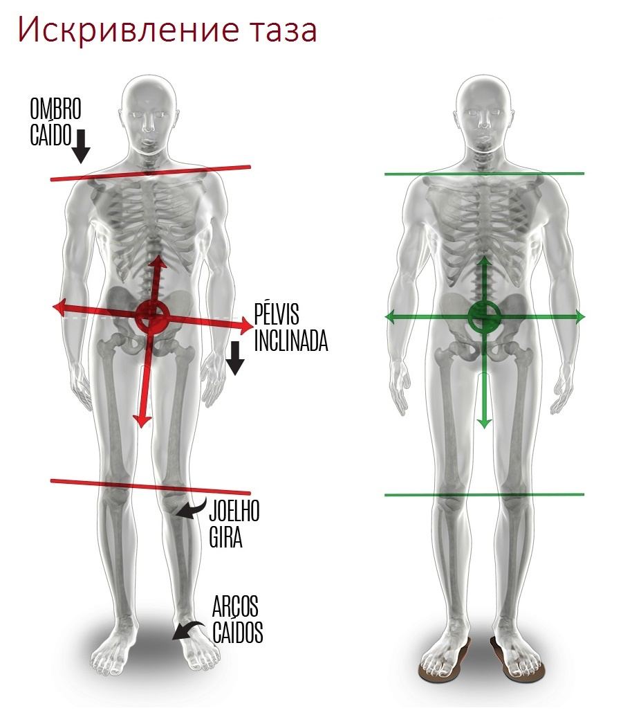 Общая асимметрия тела